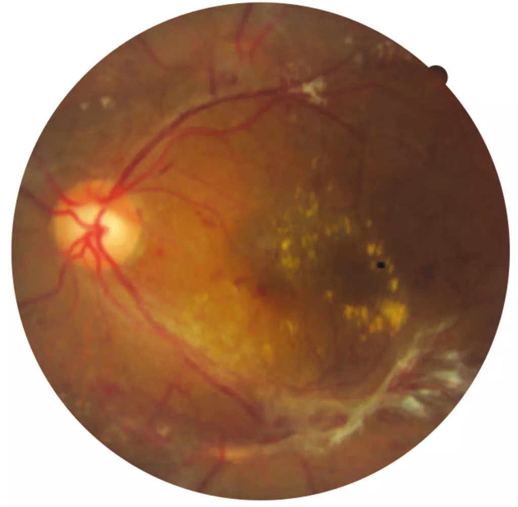Eye with severe diabetic retinopathy