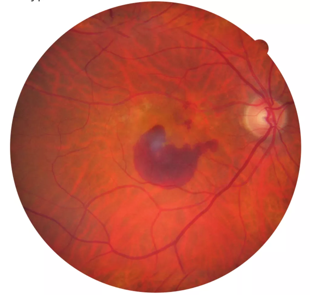 Active 'wet' ARMD with bleeding and scar in the centre of the retina.