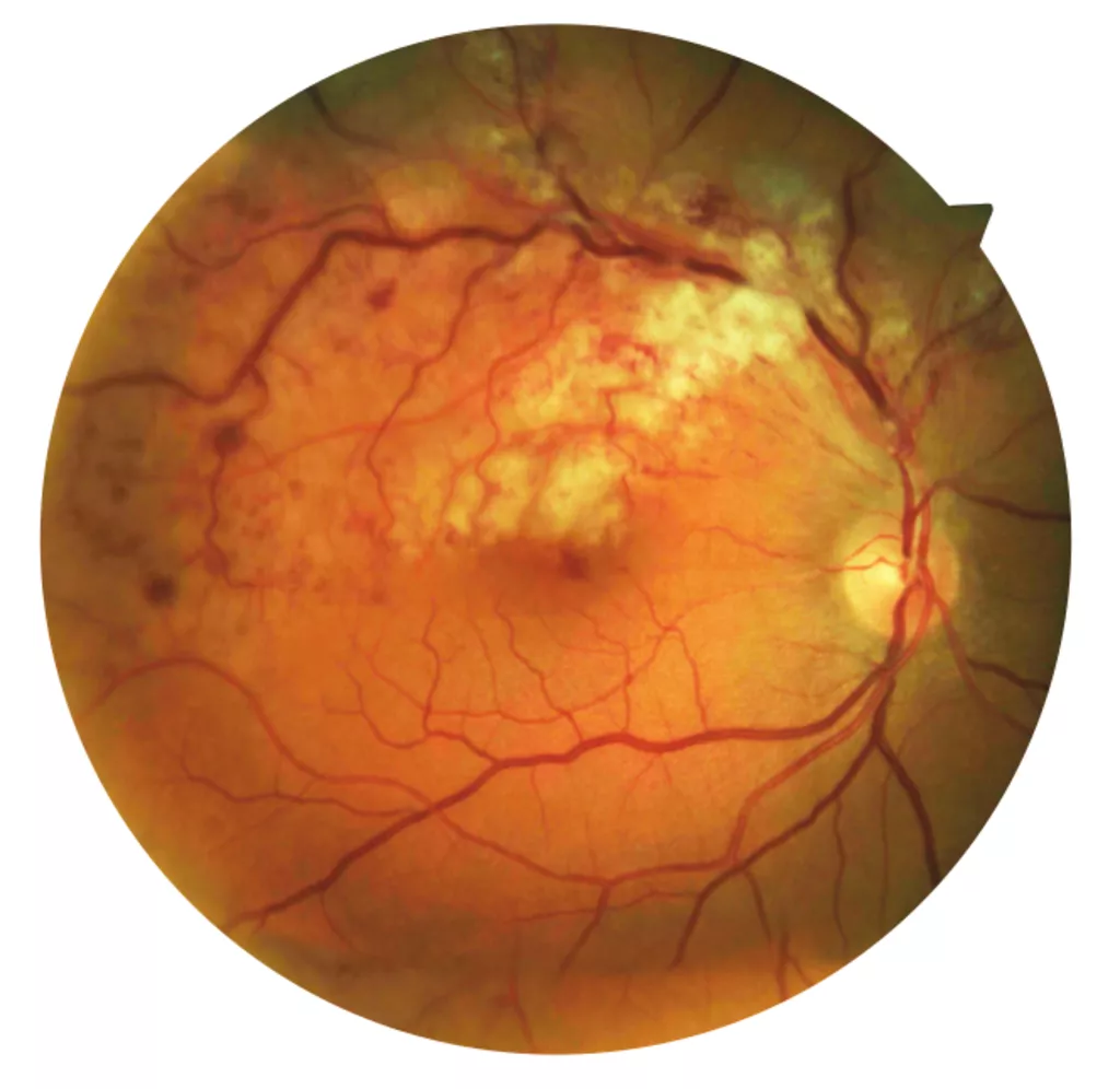 Branch Vein Occlusion on the top part of the photo with normal retina on the lower part of the eye